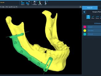 #AI-based segmentation, 3D modelling and Cutting Guides for Maxillofacial Surgical Applications